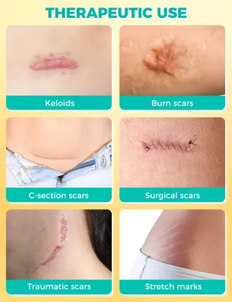 Silicone Scar Plaster, 150 cm, Reusable & Medical, for Caesarean Section, Scars & Keloid, Skin-friendly, Breathable, Waterproof