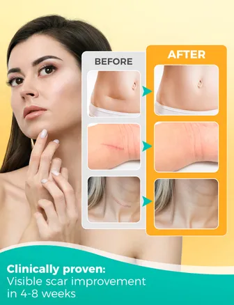 Silicone Scar Plaster, 150 cm, Reusable & Medical, for Caesarean Section, Scars & Keloid, Skin-friendly, Breathable, Waterproof