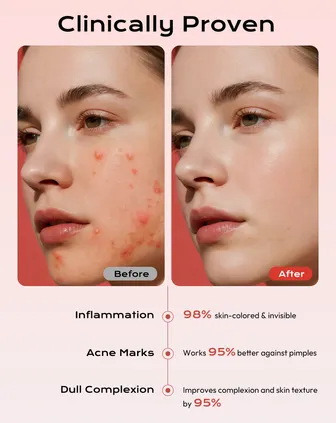 Invisible Pimple Patch - Hydrocolloid Plaster Waterproof & Breathable, Strong Absorption, Residue-Free, Acne Treatment (10 mm & 12 mm, 360 Pimple Patches)