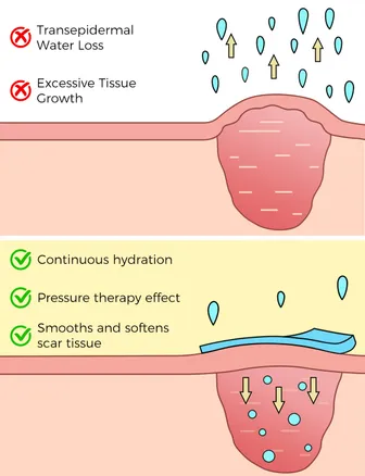 Silicone Scar Plaster, 150 cm, Reusable & Medical, for Caesarean Section, Scars & Keloid, Skin-friendly, Breathable, Waterproof